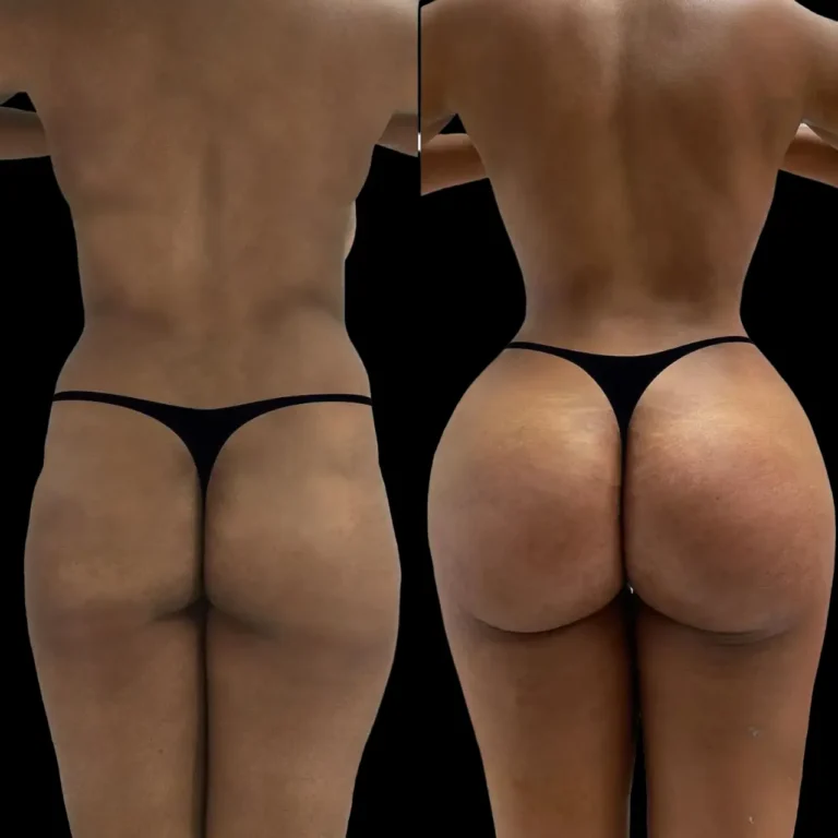 Best Doctors in Dubai Using Hyacorp Fillers for Buttocks Enhancement