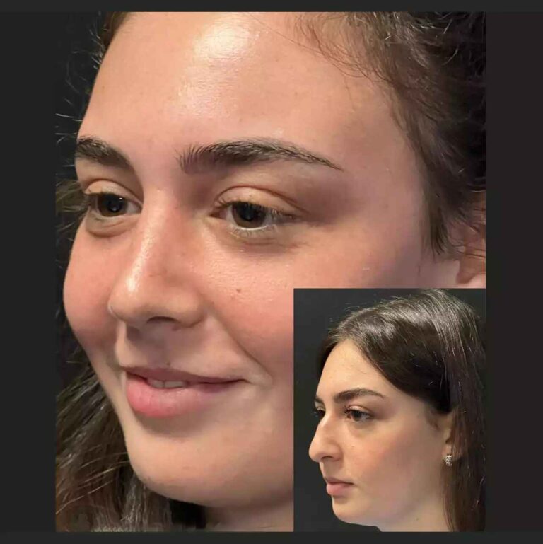 Is Rhinoplasty in Dubai Suitable for Revision Cases?