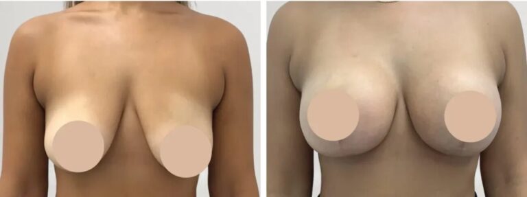 Advanced Techniques for Breast Reduction in Dubai