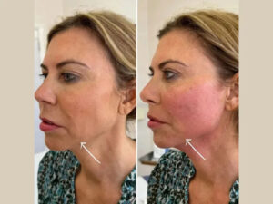 Best Doctors in dubai for Endolift Facial Sculpting Treatments