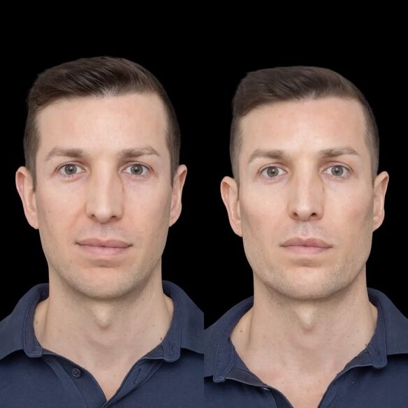 Advanced Jawline Fillers for Facial Balance by Best Doctors in Dubai