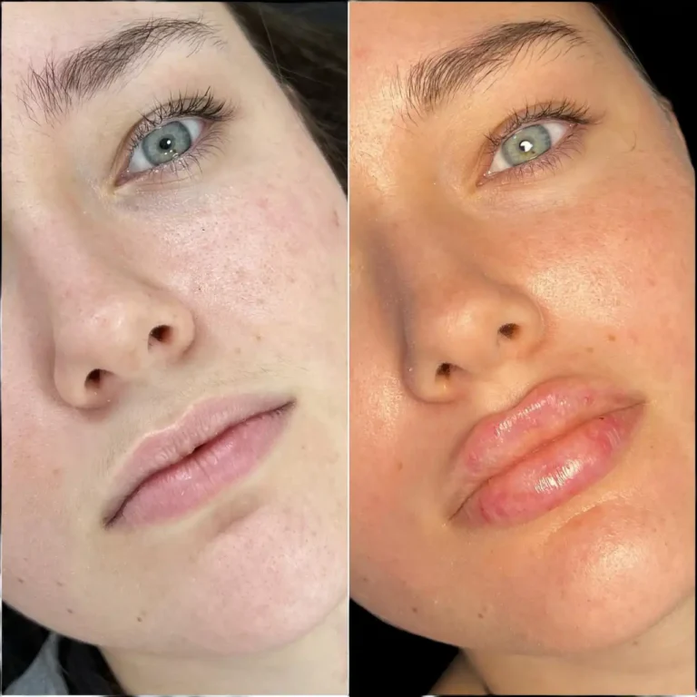 Fillers Treatments in Dubai for a Luxurious Beauty Experience