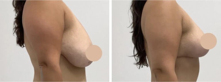 Breast Lift in Dubai with Innovative Surgical Techniques