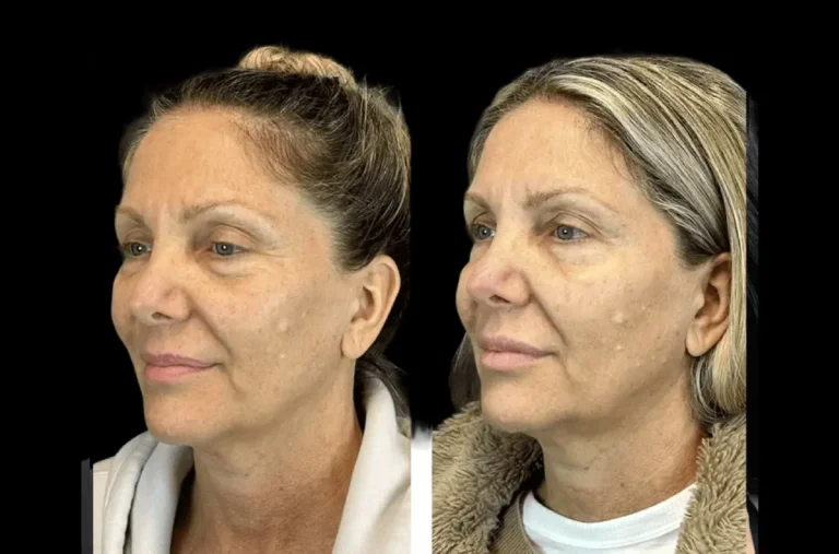Why Botox Treatments in Dubai Are the Top Choice for Modern Anti-Aging Solutions
