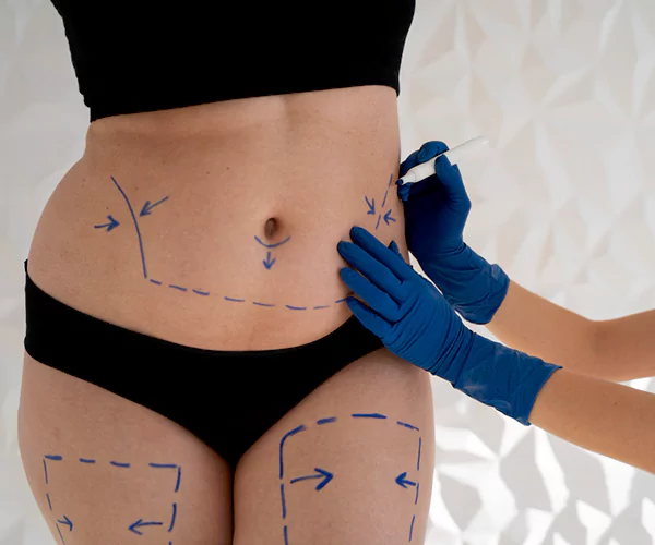 Liposuction in Dubai for Targeted Fat Reduction Solutions