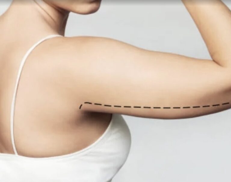 Dubai as a Leading Destination for Arm Liposuction