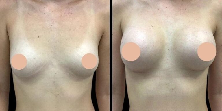 Breast Augmentation in Dubai: Choosing the Right Surgeon for Safe Results