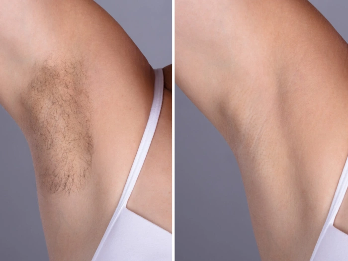 Best Doctors in dubai: Laser hair removal and Skin Rejuvenation