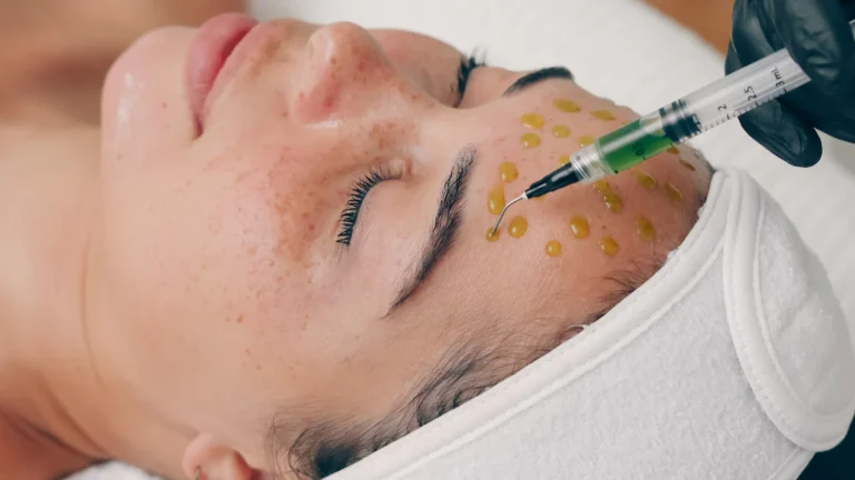 Best Microneedling Treatments in San Francisco for Glowing Skin