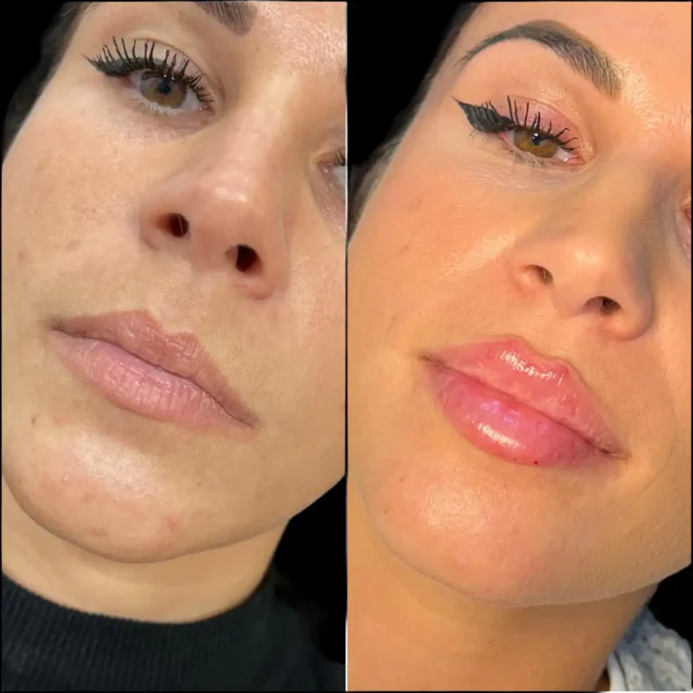 Best Doctors in Dubai for Russian Lip Fillers for Natural Vertical Lift